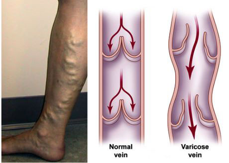 varicose-veins-1-1